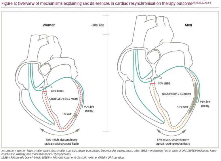 Explaining Sex Differences In Cardiac Resynchronisation