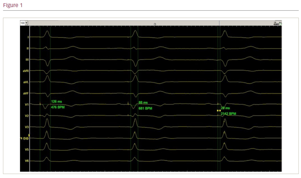 Conduction System Pacing And Av Node Ablation Glenfield Stepwise Approach For Perfection