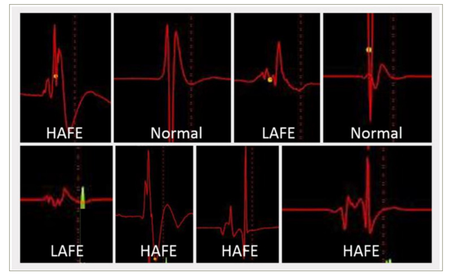 Figure 2: Three types of bipolar atrial electrogram for ganglionated plexus mapping