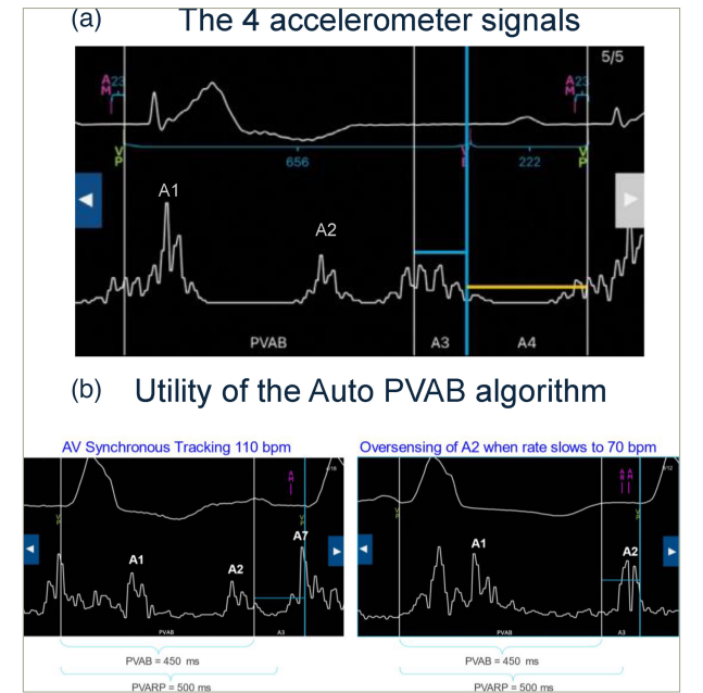 Figure 1: Atrial sensing by the Micra AV device: How does it work?