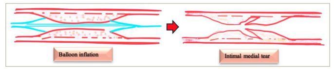 Figure 1: Mechanism of balloon angioplasty