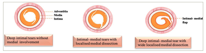 Figure 2: Diagram showing morphological correlates of angiographic appearances of intraluminal flaps and haziness