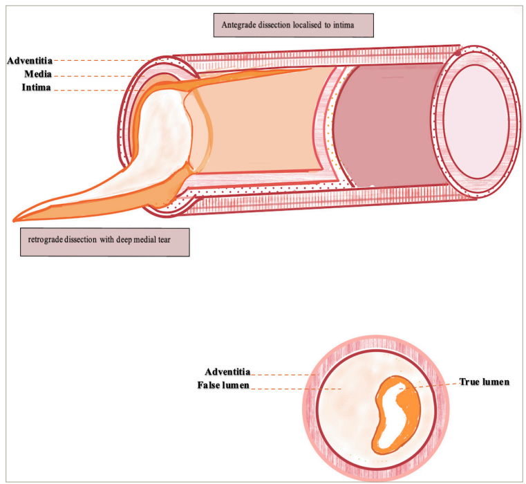 Figure 3: Morphological correlation of angiographic appearances of complicated coronary arterial dissection