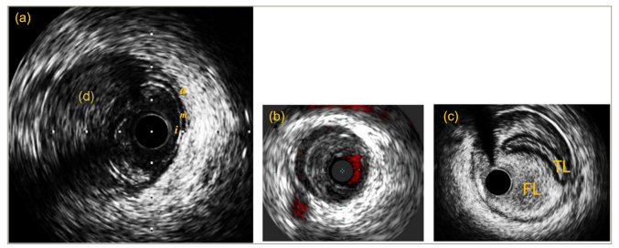 Figure 4: Intravascular ultrasound images of coronary dissections during percutaneous coronary intervention