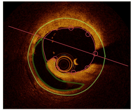 Figure 5: Measurement of dissection area by optical coherence tomography (QCU-CMS)64