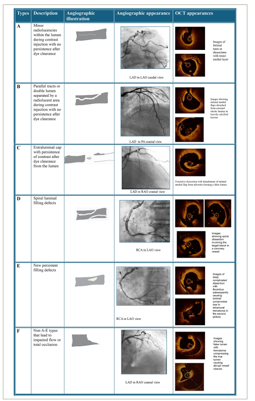 Table 1: NHLBI classification of types of coronary artery dissections during angioplasty