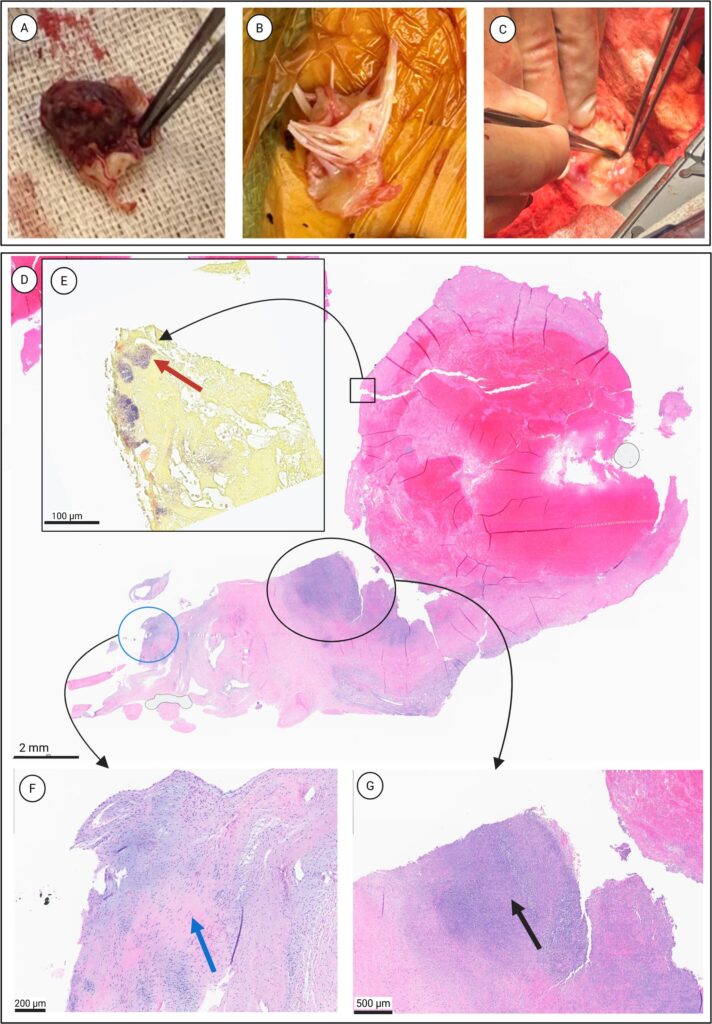 Figure 2: Surgical and histopathologic correlation of infective endocarditis with mitral valve destruction and left ventricular pseudoaneurysm