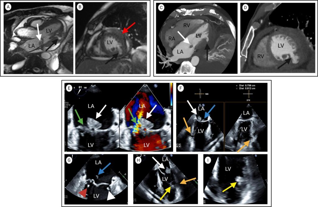 Figure 1: Multimodality imaging of infective endocarditis complicated by mitral valve vegetations, left ventricular abscess and left ventricular pseudoaneurysm
